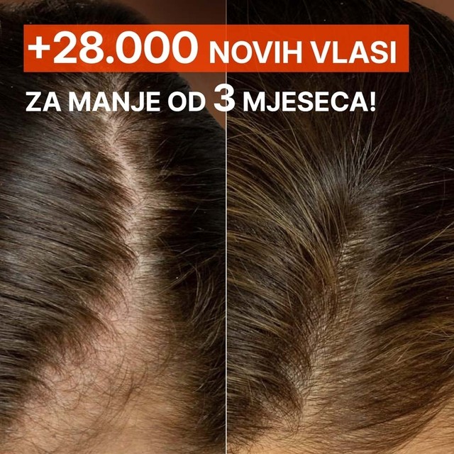 rossen-10012344-nove-vlasi-rezultat-3-mjeseca-piskavica-ampula